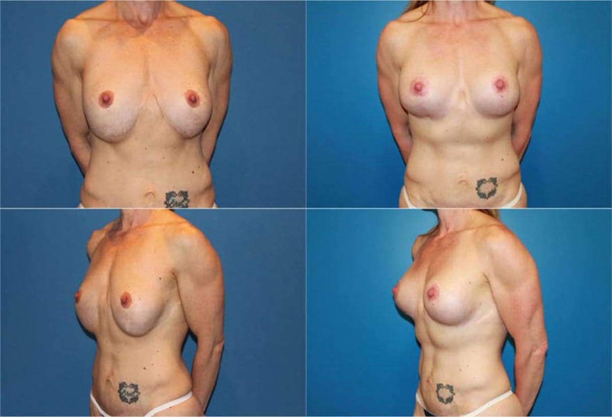 Reductive Augmentation of the Breast Before & After Gallery - Patient 132439 - Image 1