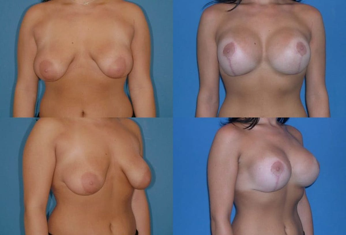 Reductive Augmentation of the Breast Before & After Gallery - Patient 171984 - Image 1