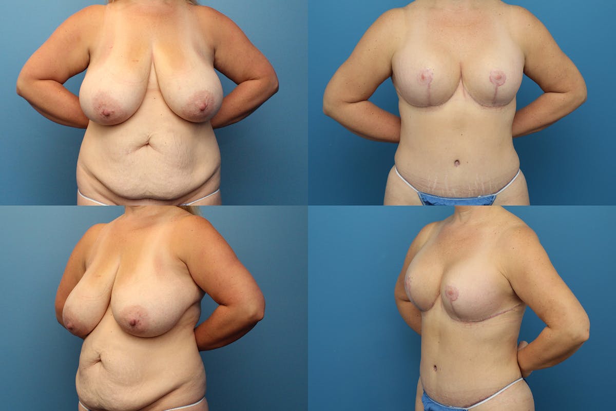 Reductive Augmentation of the Breast Before & After Gallery - Patient 131107 - Image 1