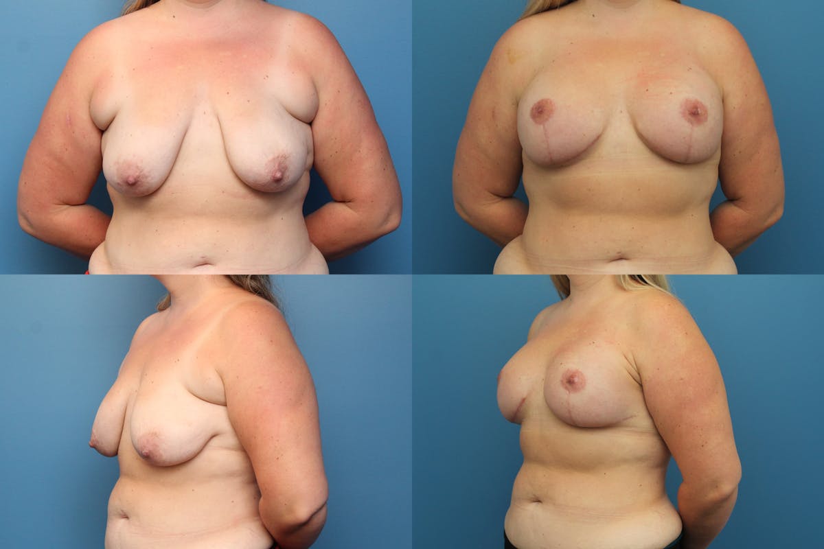 Reductive Augmentation of the Breast Before & After Gallery - Patient 351026 - Image 1