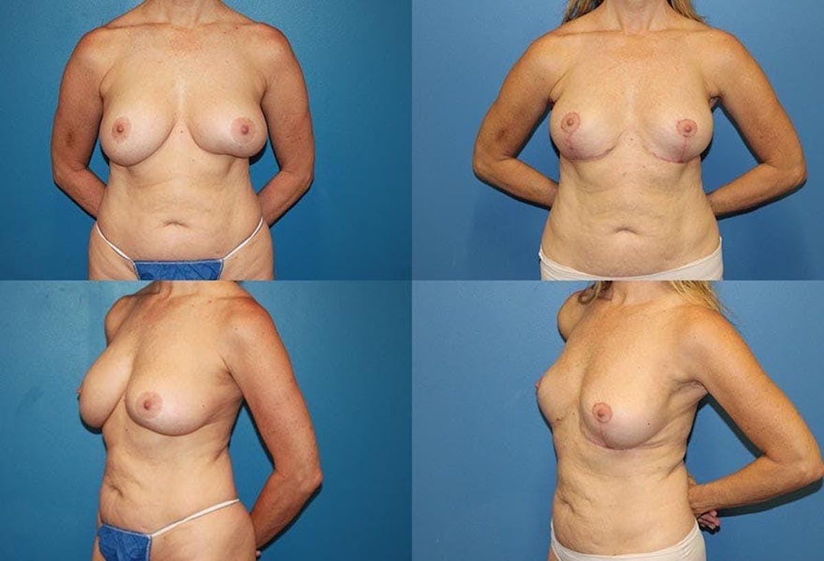 En Bloc Capsulectomy Before & After Gallery - Patient 299939 - Image 1