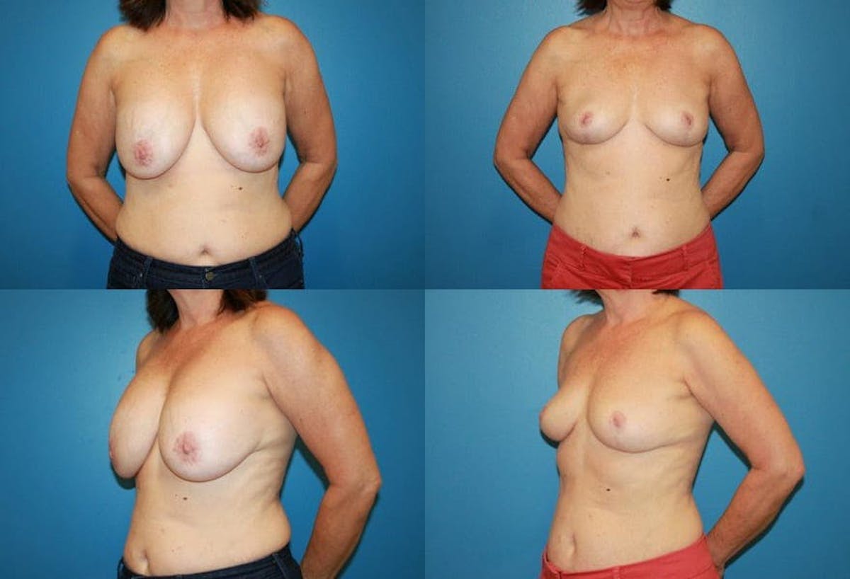 En Bloc Capsulectomy Before & After Gallery - Patient 292473 - Image 1
