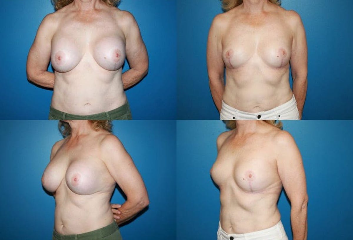 En Bloc Capsulectomy Before & After Gallery - Patient 295384 - Image 1