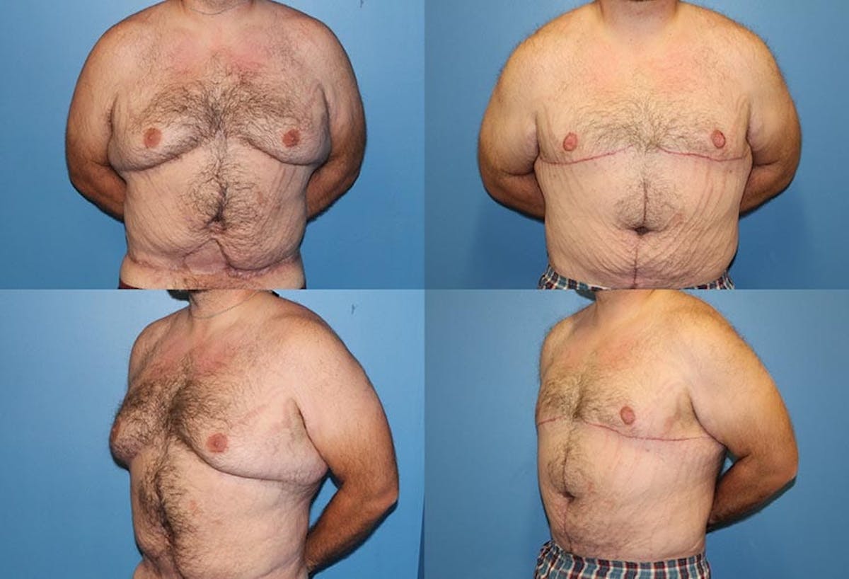 Male Breast Reduction / Gynecomastia Before & After Gallery - Patient 322736 - Image 1