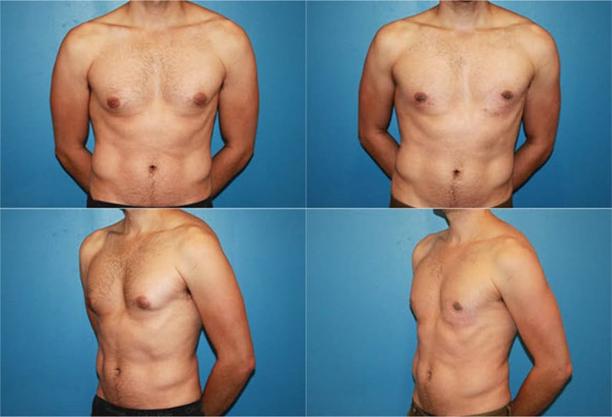 Male Breast Reduction / Gynecomastia Before & After Gallery - Patient 735223 - Image 1
