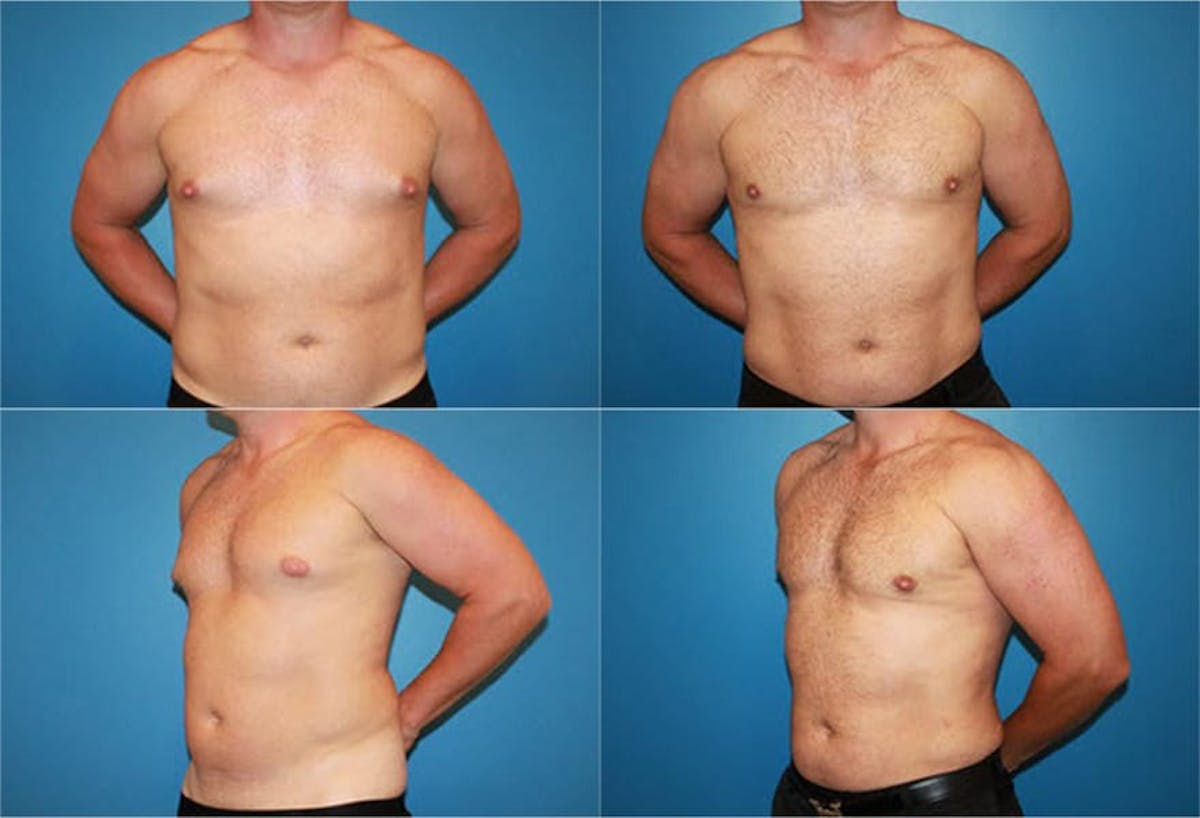 Male Breast Reduction / Gynecomastia Before & After Gallery - Patient 377446 - Image 1