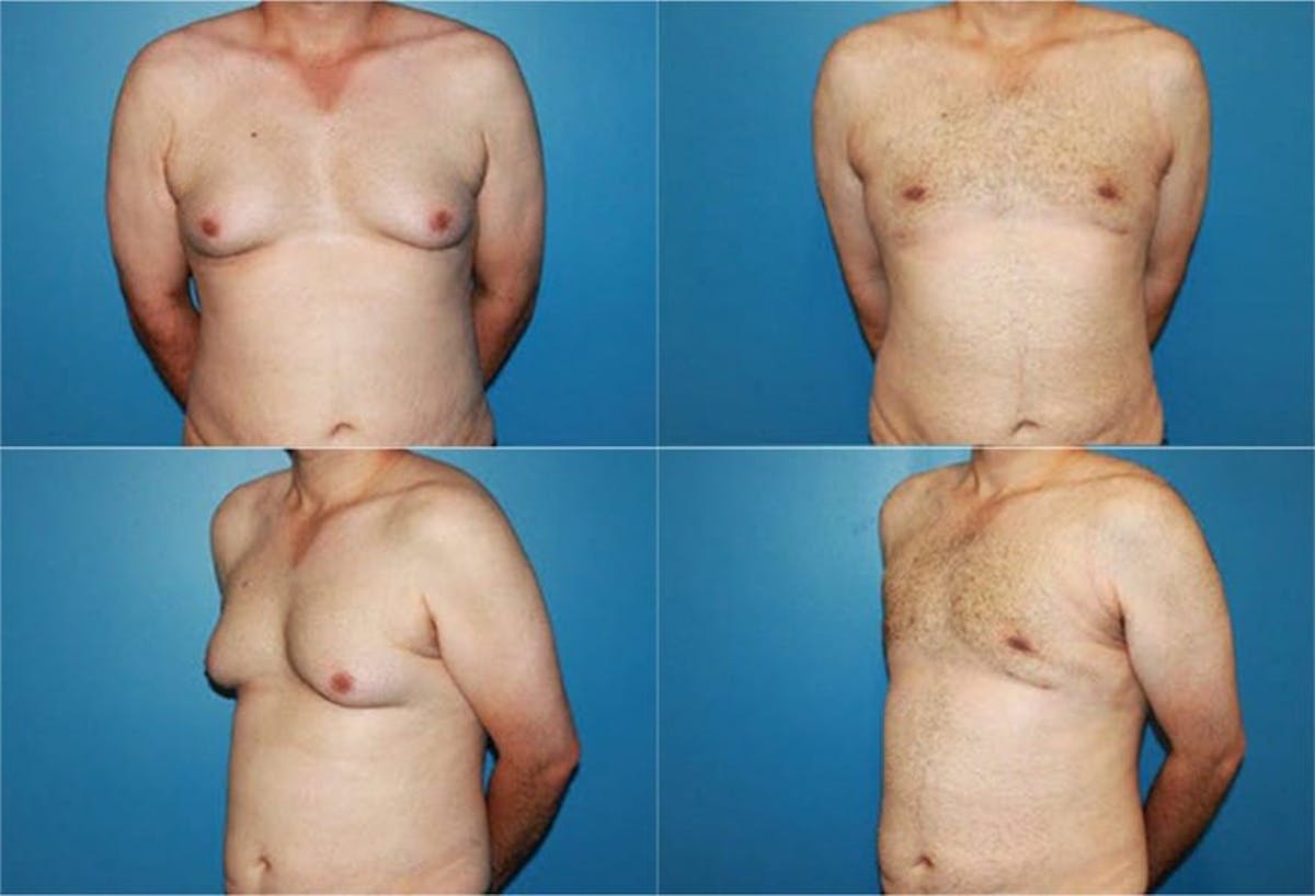 Male Breast Reduction / Gynecomastia Before & After Gallery - Patient 420698 - Image 1