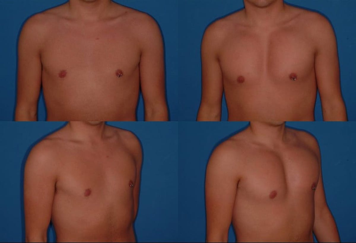 Pectoral Augmentation Before & After Gallery - Patient 744568 - Image 1