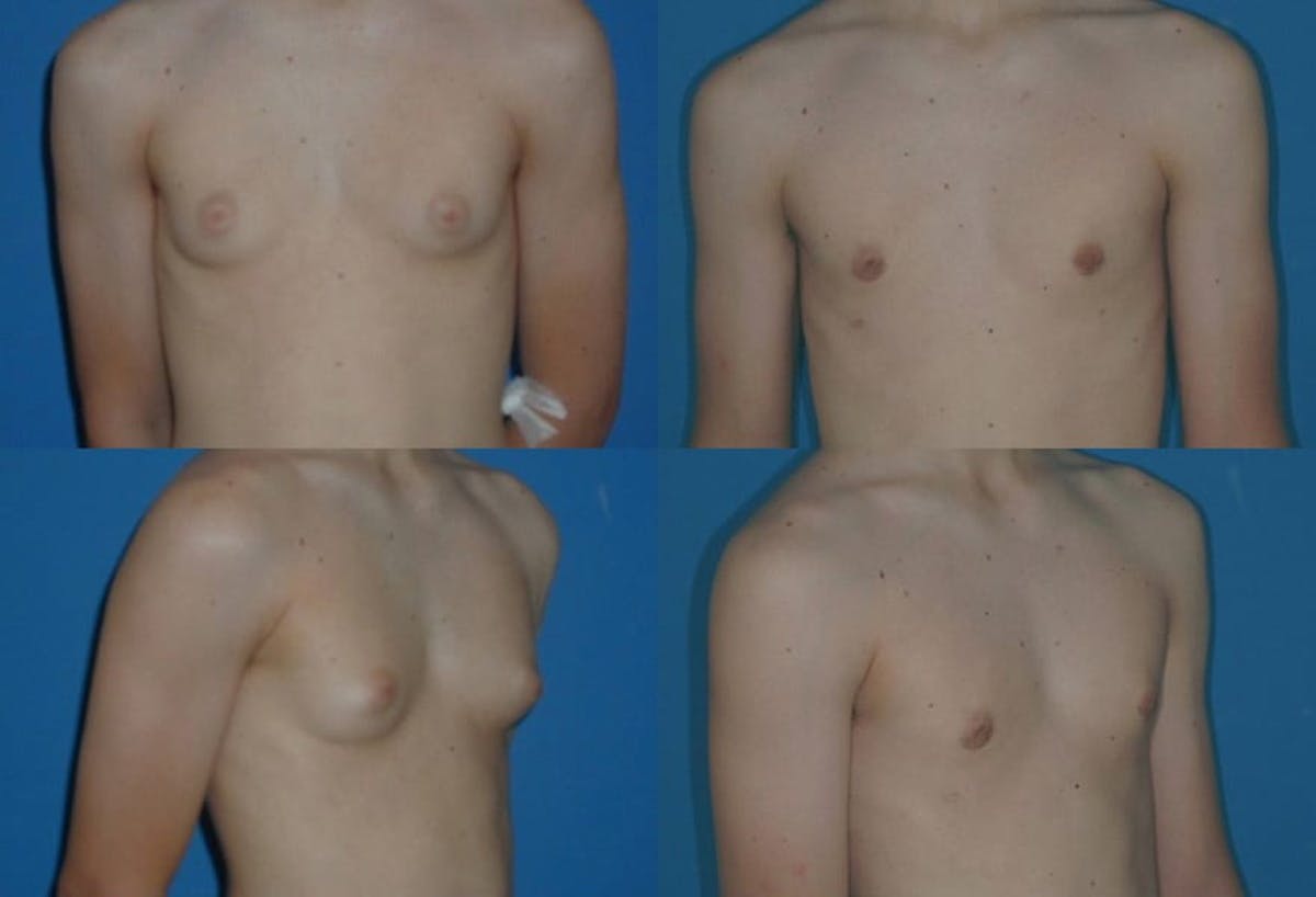 Male Breast Reduction / Gynecomastia Before & After Gallery - Patient 118892 - Image 1