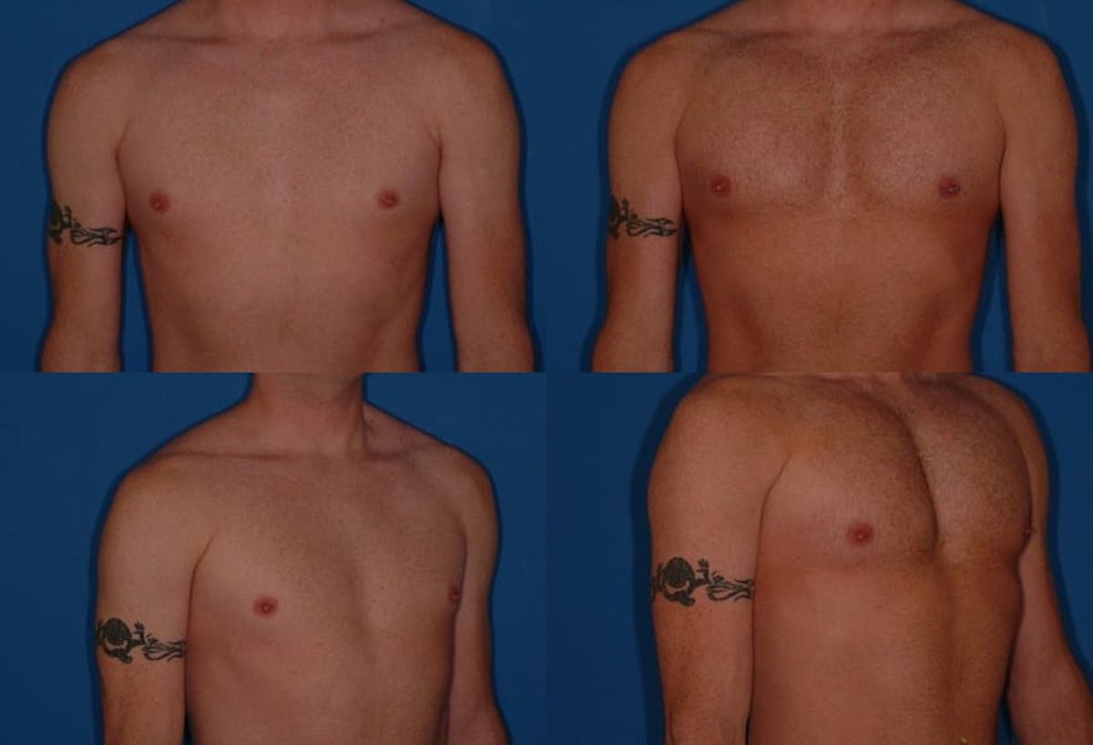 Pectoral Augmentation Before & After Gallery - Patient 263301 - Image 1