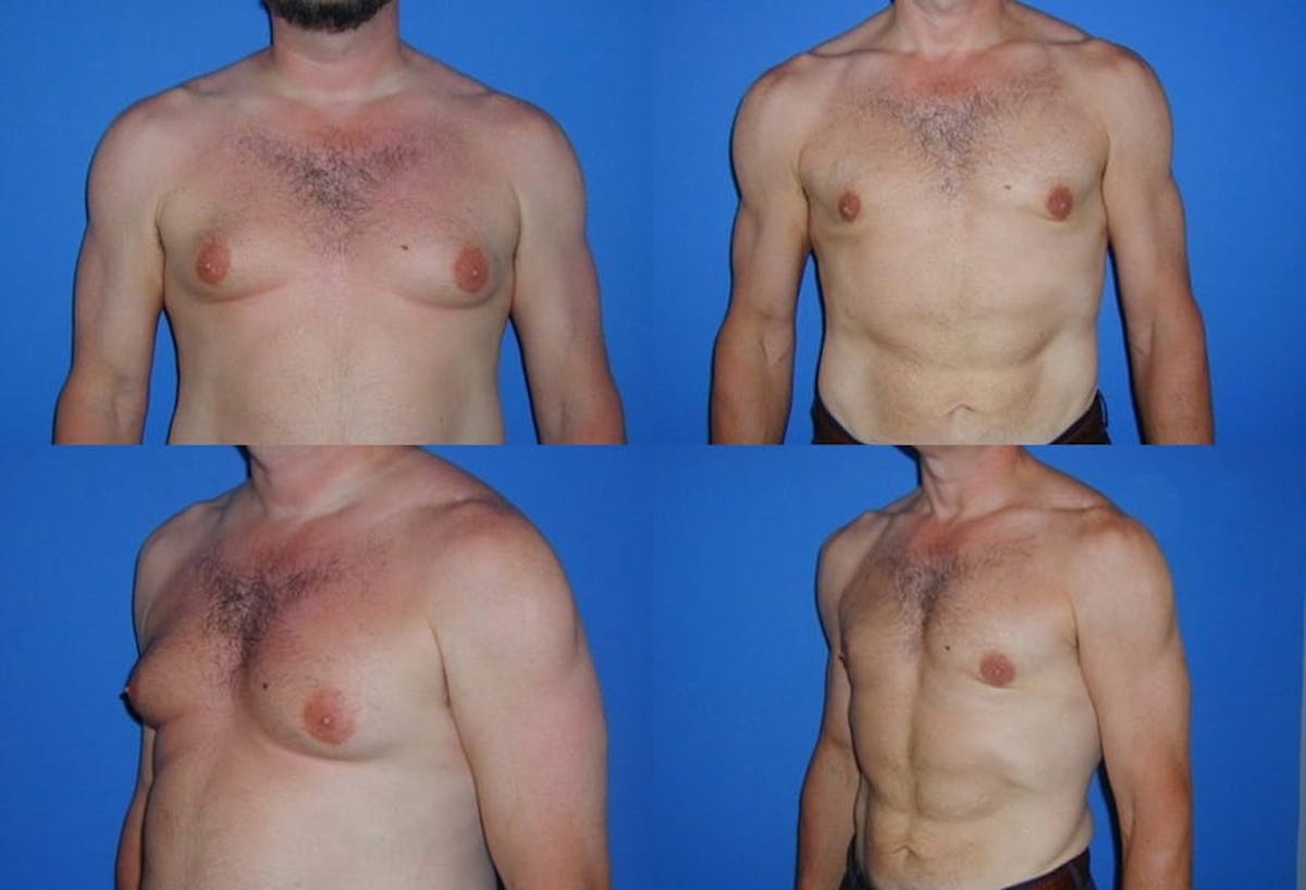 Male Breast Reduction / Gynecomastia Before & After Gallery - Patient 419214 - Image 1