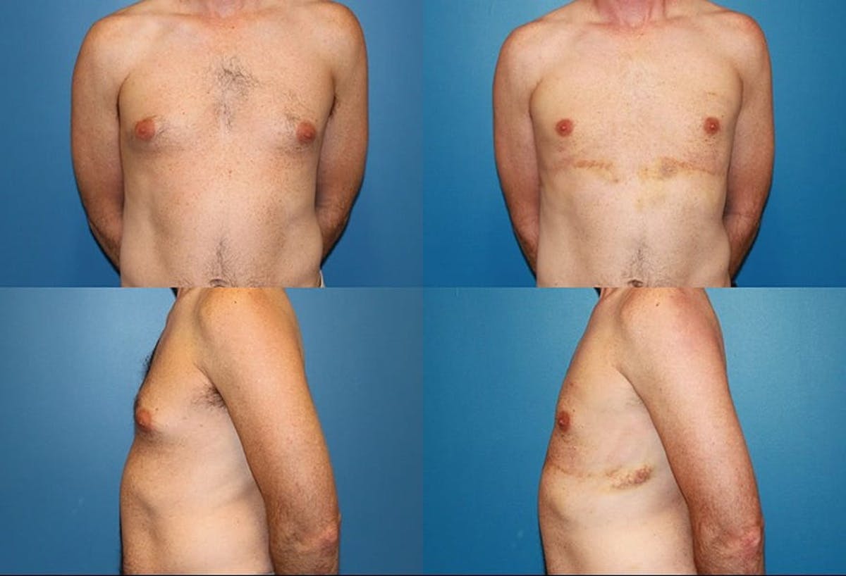 Male Breast Reduction / Gynecomastia Before & After Gallery - Patient 133542 - Image 1