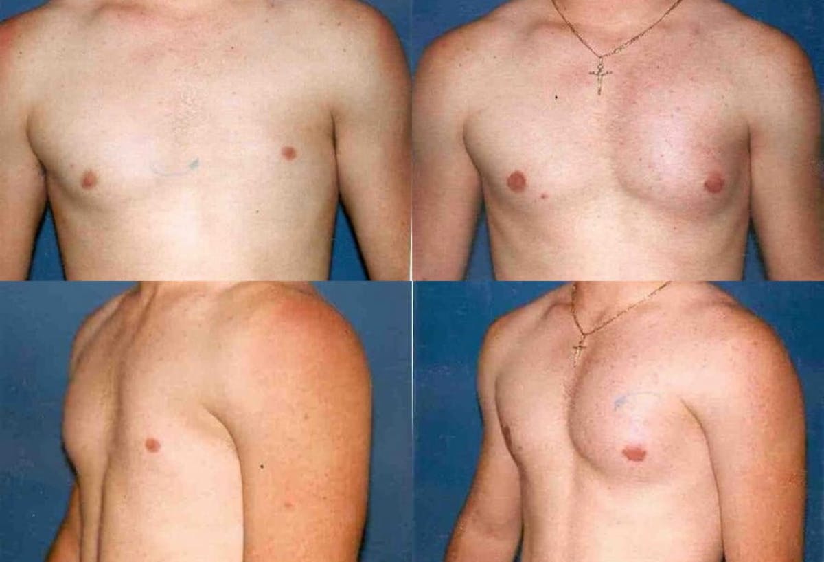 Pectoral Augmentation Before & After Gallery - Patient 408570 - Image 1