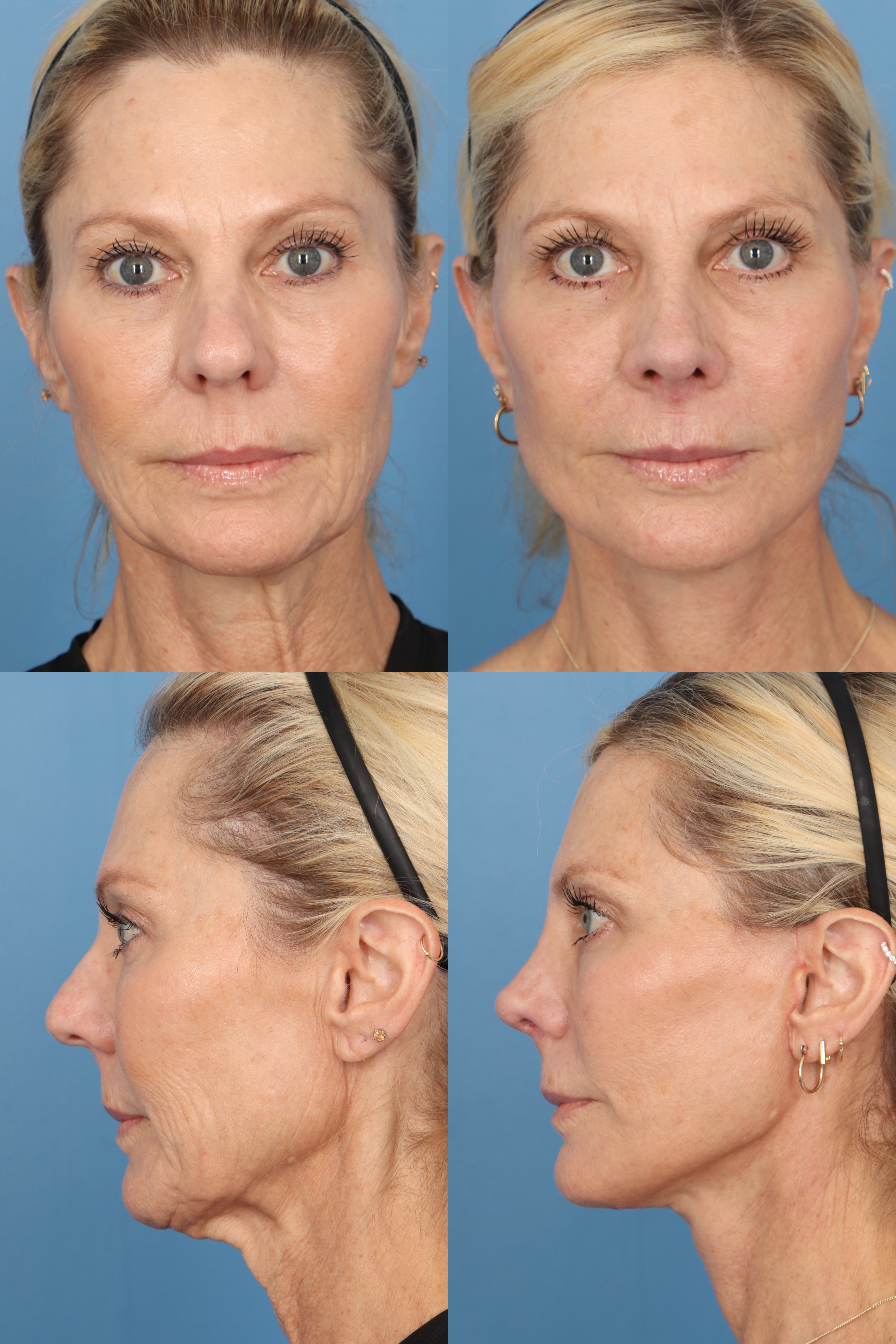 Patient 392549 | Facelift Photo Gallery Before & After Photos