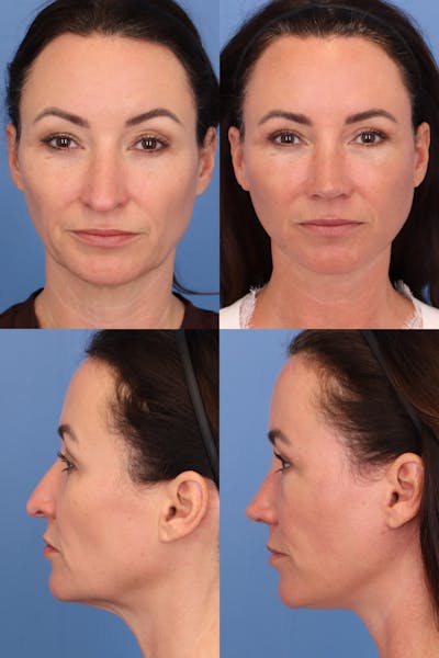 Facelift Photo Gallery Before & After Gallery - Patient 107823 - Image 1