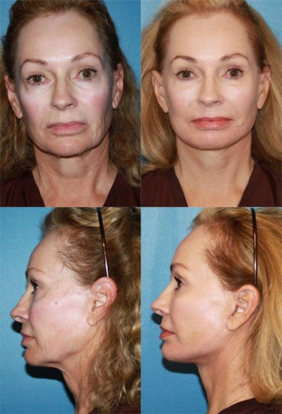Facelift Photo Gallery Before & After Gallery - Patient 278121 - Image 1