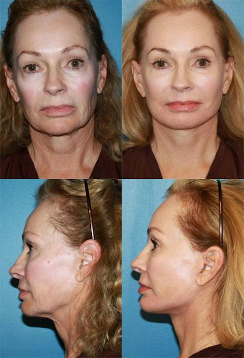 Patient 2 Before - Mini Facelift