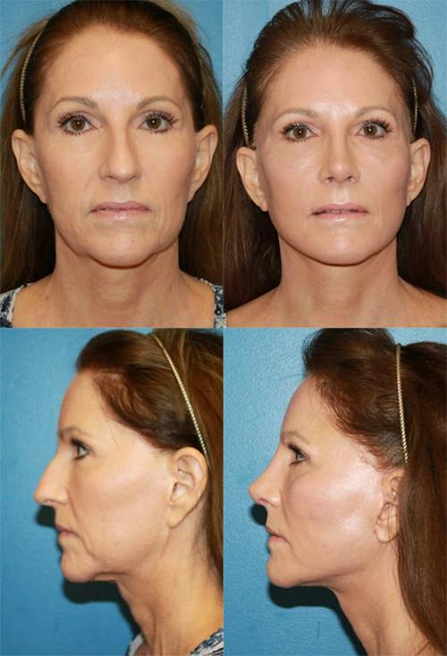 Patient 3 Before - Mini Facelift