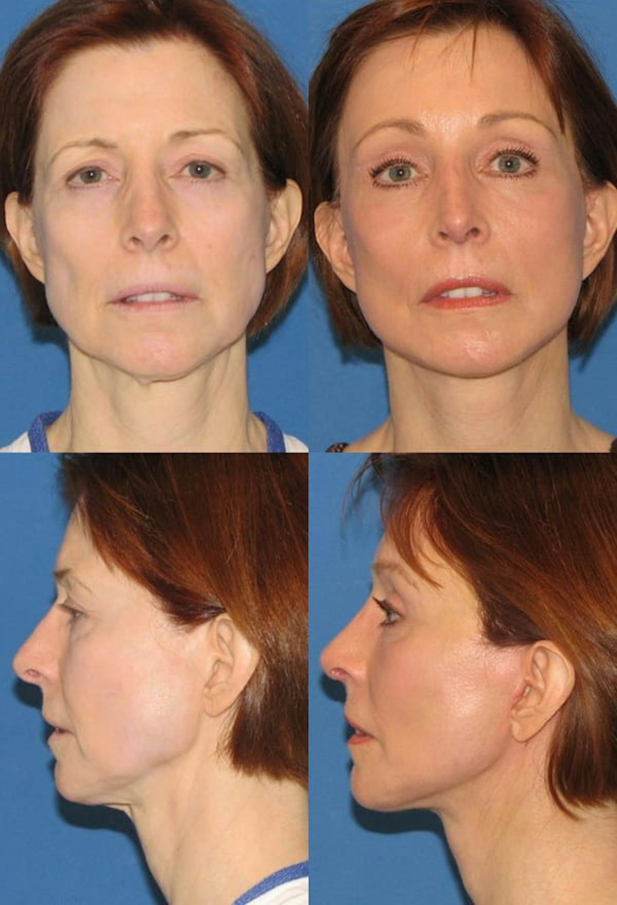 Mini Facelift Before & After Gallery - Patient 412534 - Image 1