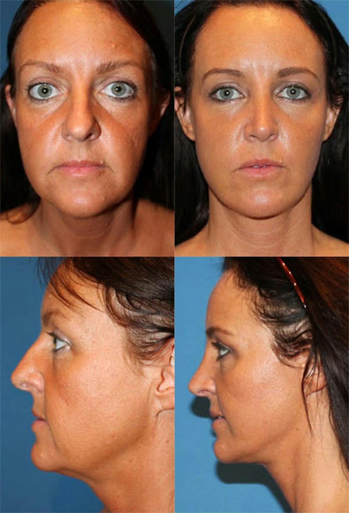 Mini Facelift Before & After Gallery - Patient 418141 - Image 1