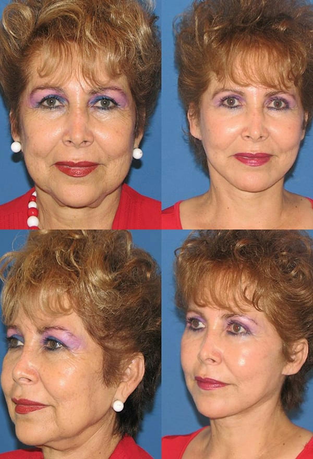 Mini Facelift Before & After Gallery - Patient 159573 - Image 1