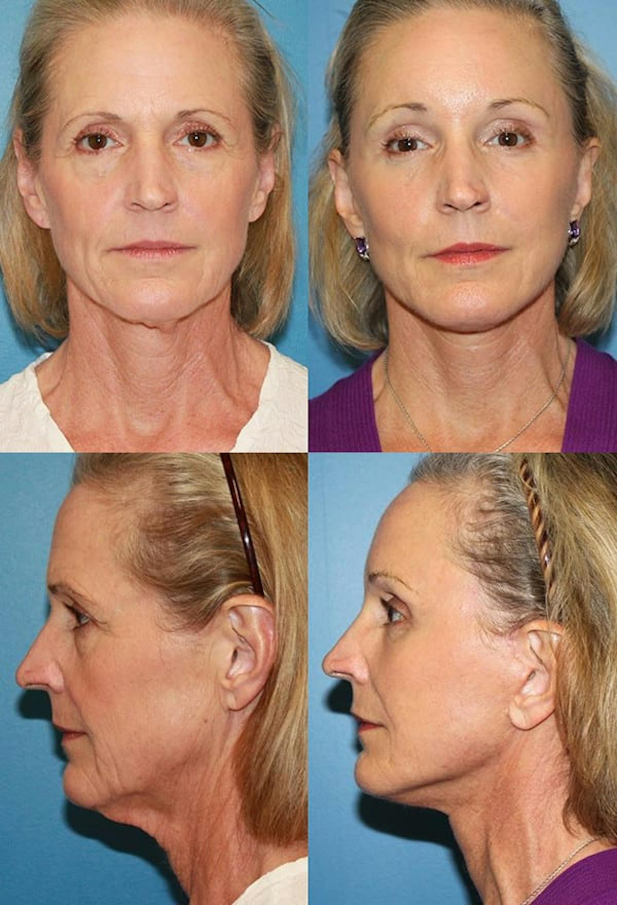 Mini Facelift Before & After Gallery - Patient 421576 - Image 1