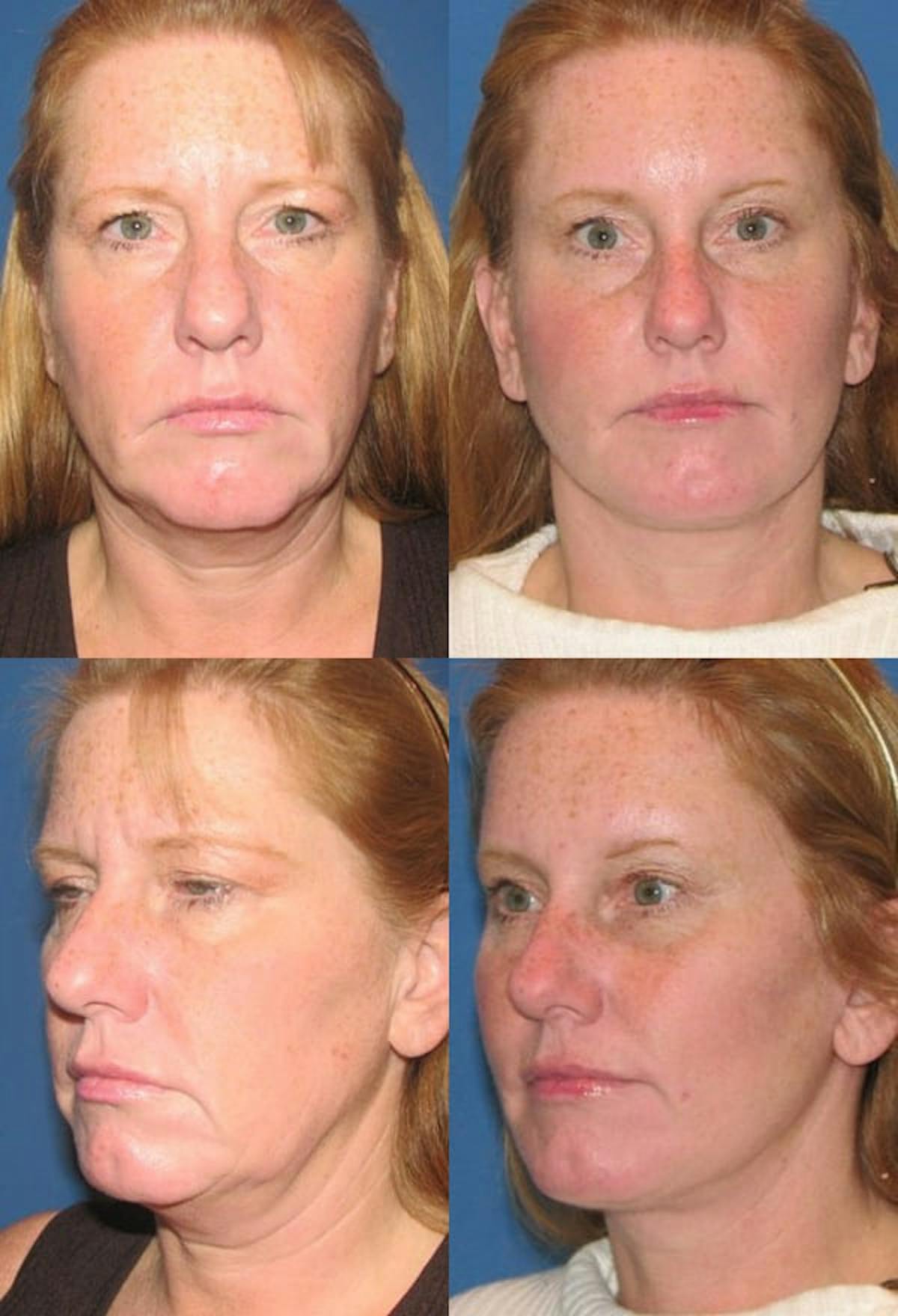 Mini Facelift Before & After Gallery - Patient 377081 - Image 1