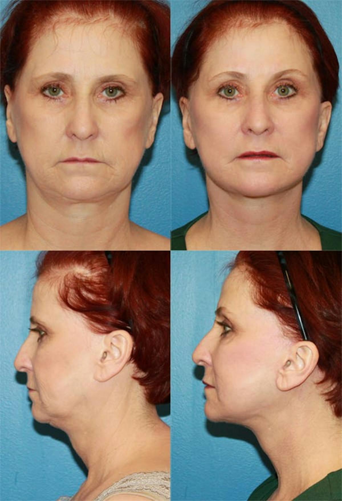 Mini Facelift Before & After Gallery - Patient 254520 - Image 1