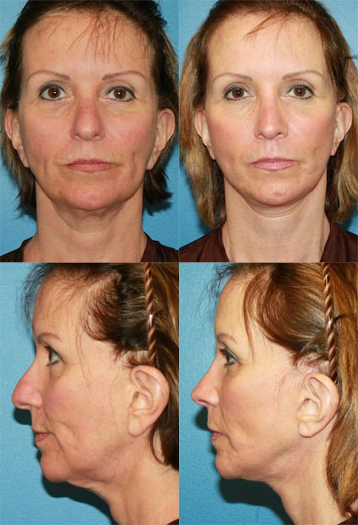 Mini Facelift Before & After Gallery - Patient 379517 - Image 1