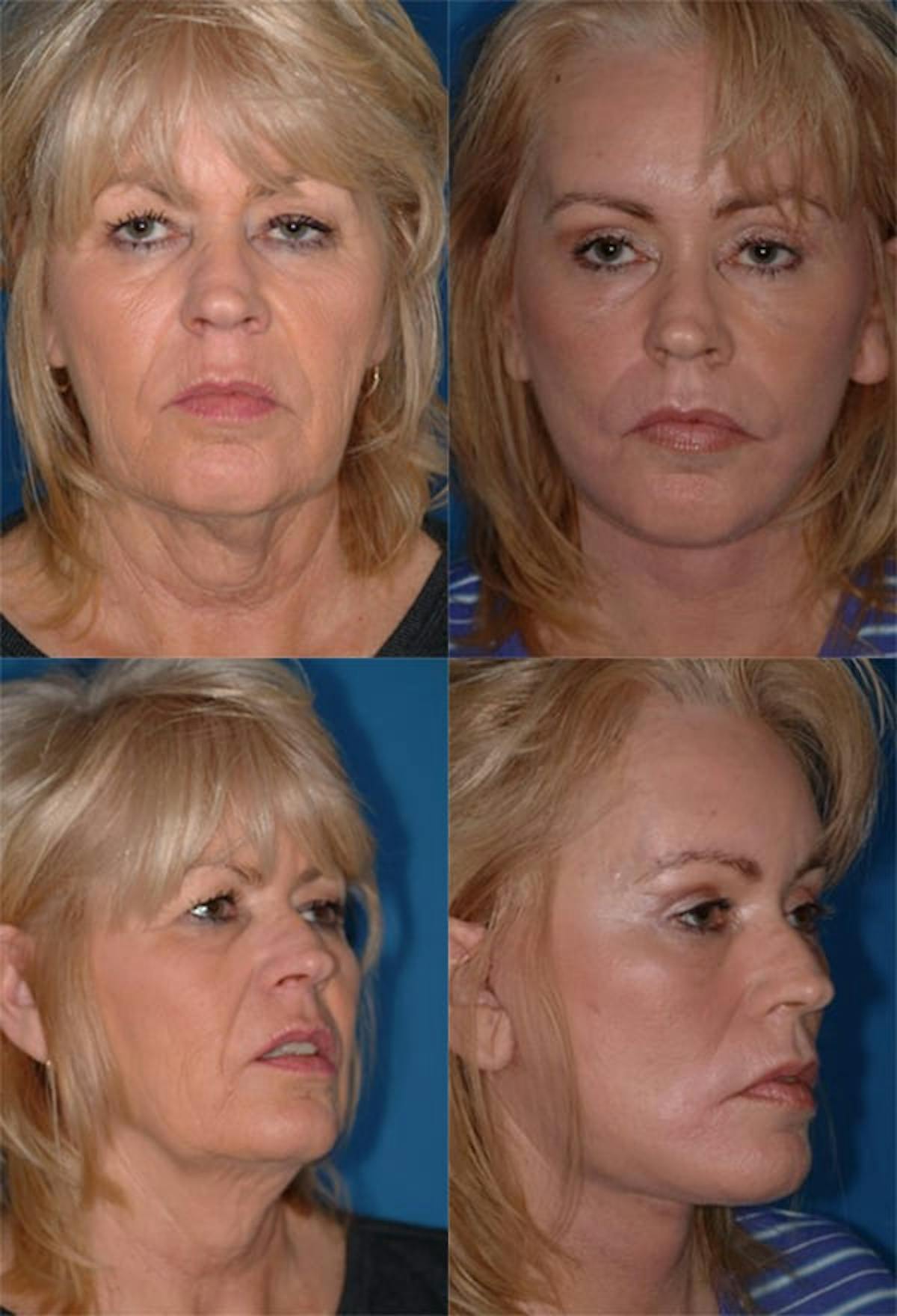 Mini Facelift Before & After Gallery - Patient 261282 - Image 1