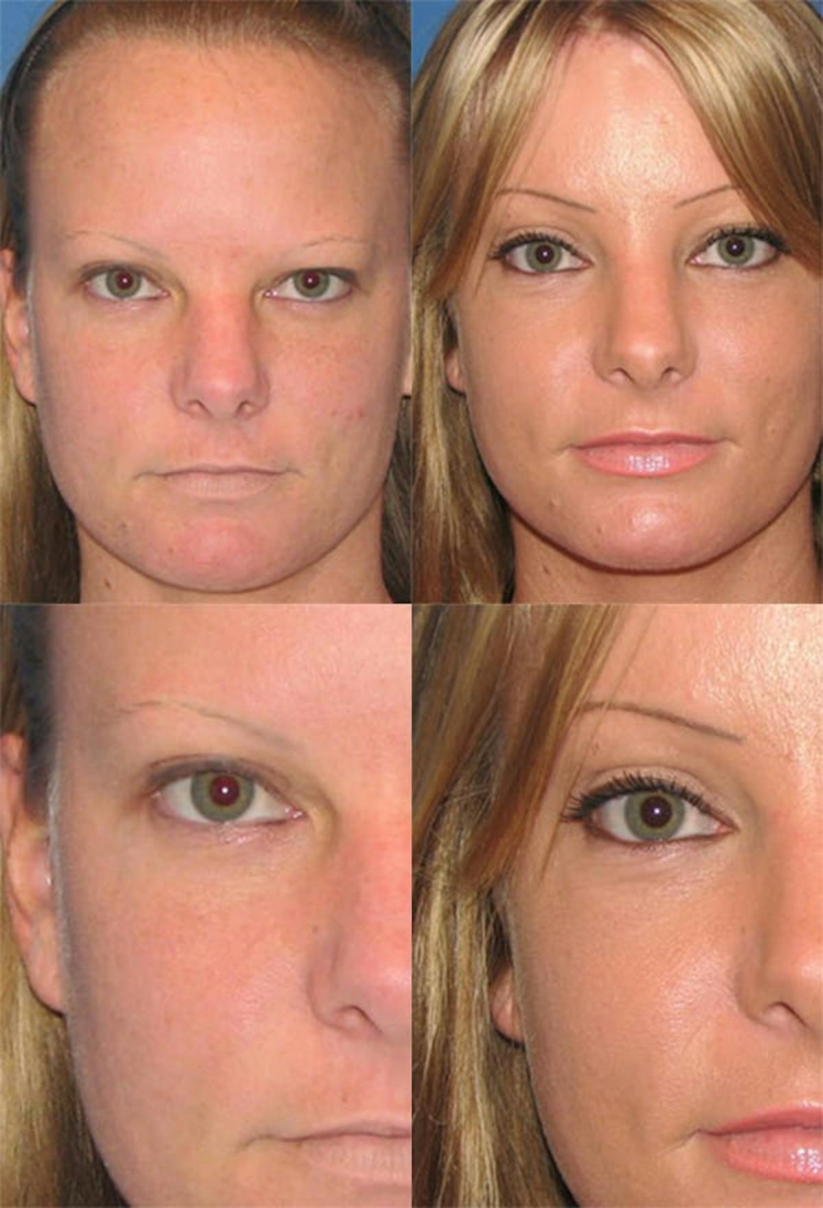 Brow Lift Before & After Gallery - Patient 139843 - Image 1