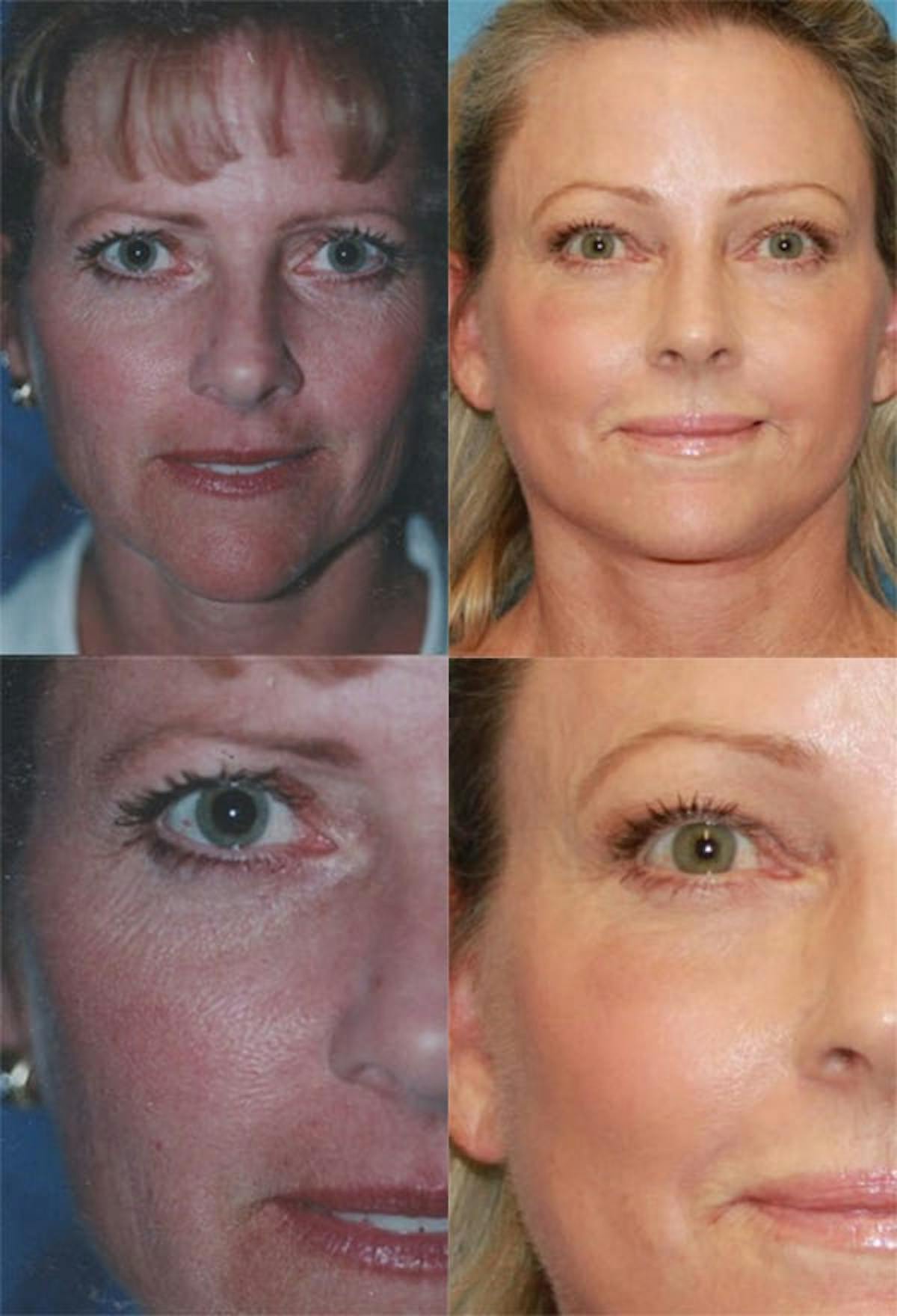 Brow Lift Before & After Gallery - Patient 147345 - Image 1
