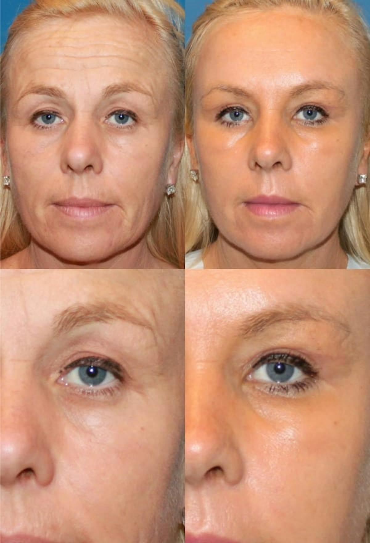 Brow Lift Before & After Gallery - Patient 393471 - Image 1