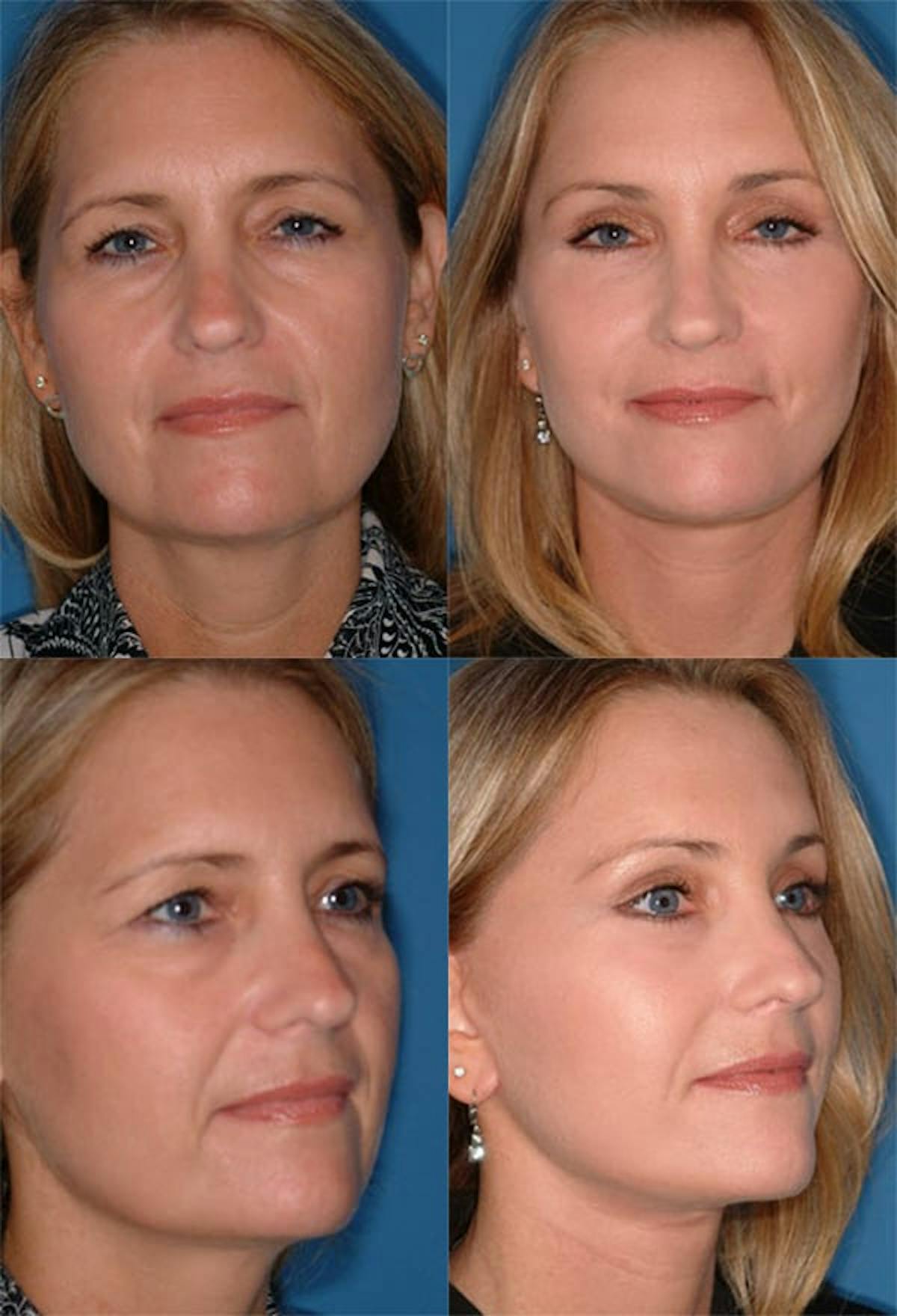 Brow Lift Before & After Gallery - Patient 685269 - Image 1