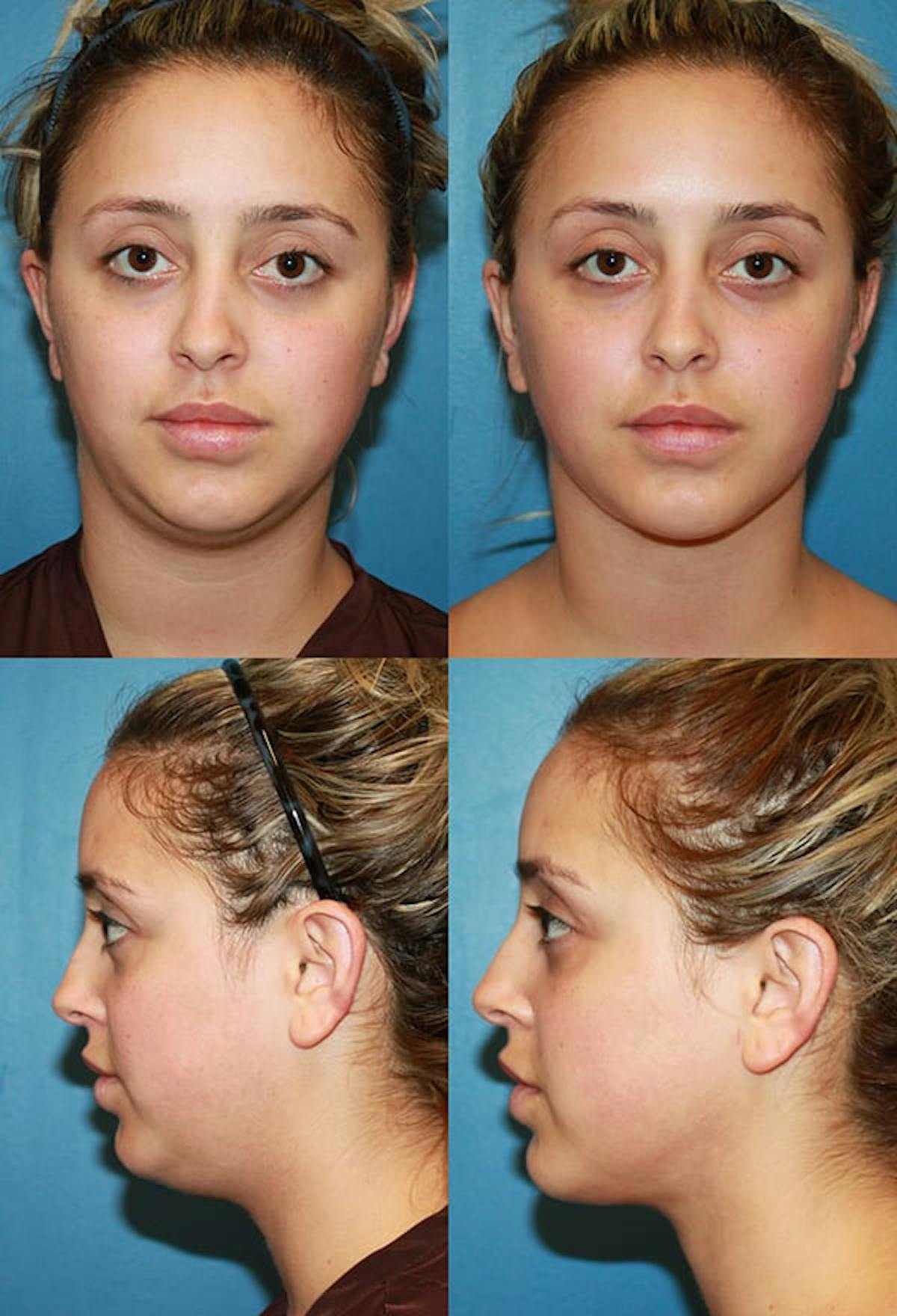 Neck Liposuction Before & After Gallery - Patient 122470 - Image 1