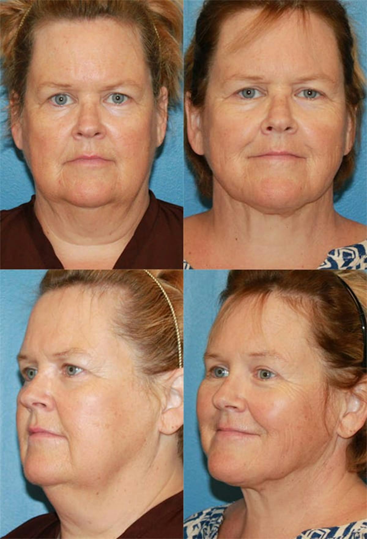 Neck Liposuction Before & After Gallery - Patient 222768 - Image 1