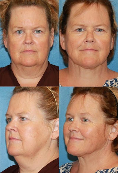 Neck Liposuction Before & After Gallery - Patient 222768 - Image 1