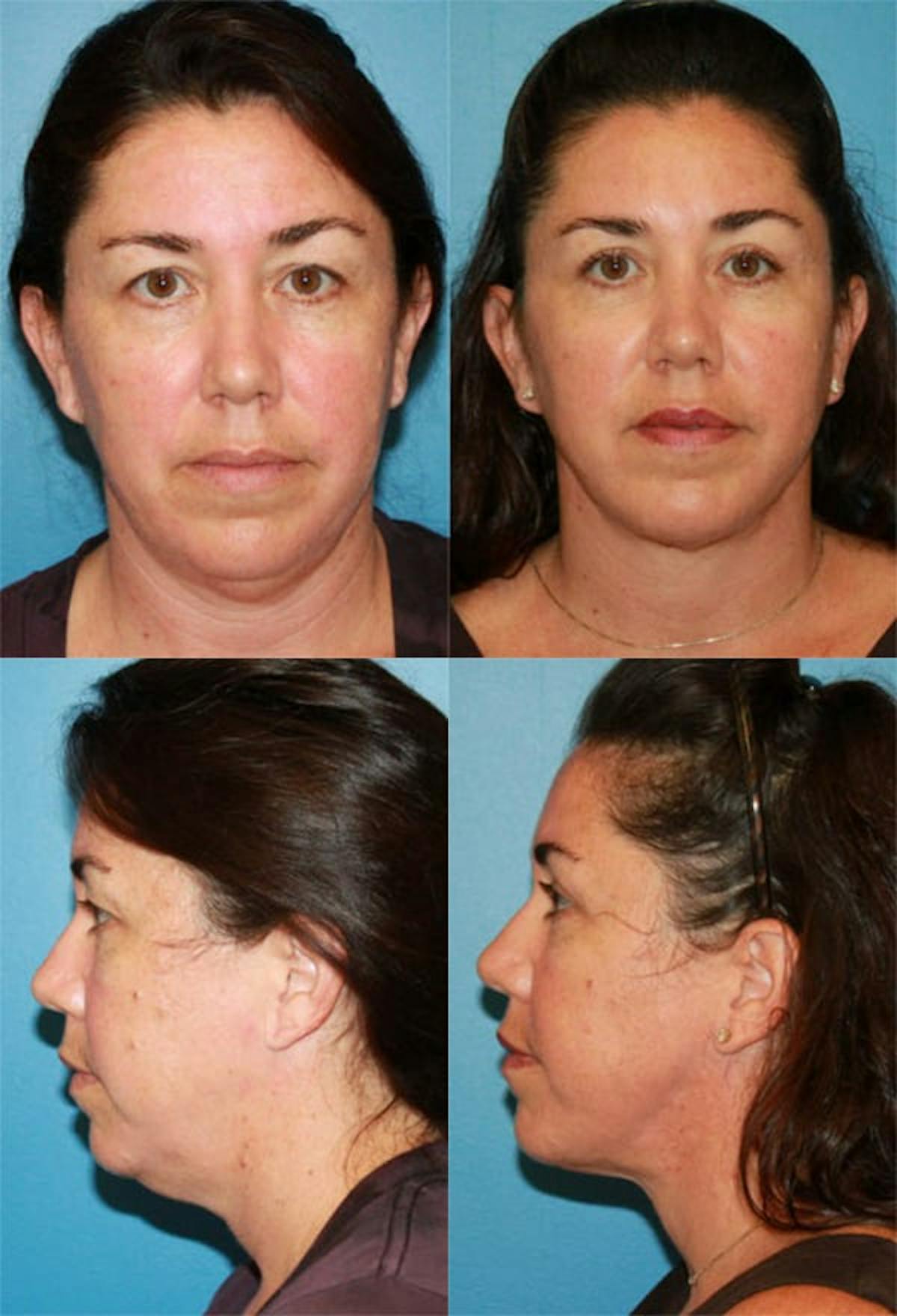 Neck Liposuction Before & After Gallery - Patient 404083 - Image 1
