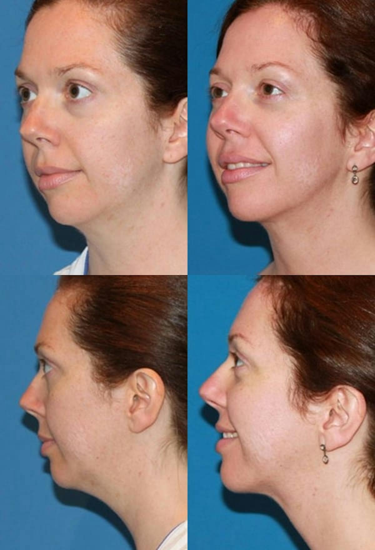 Neck Liposuction Before & After Gallery - Patient 406300 - Image 1
