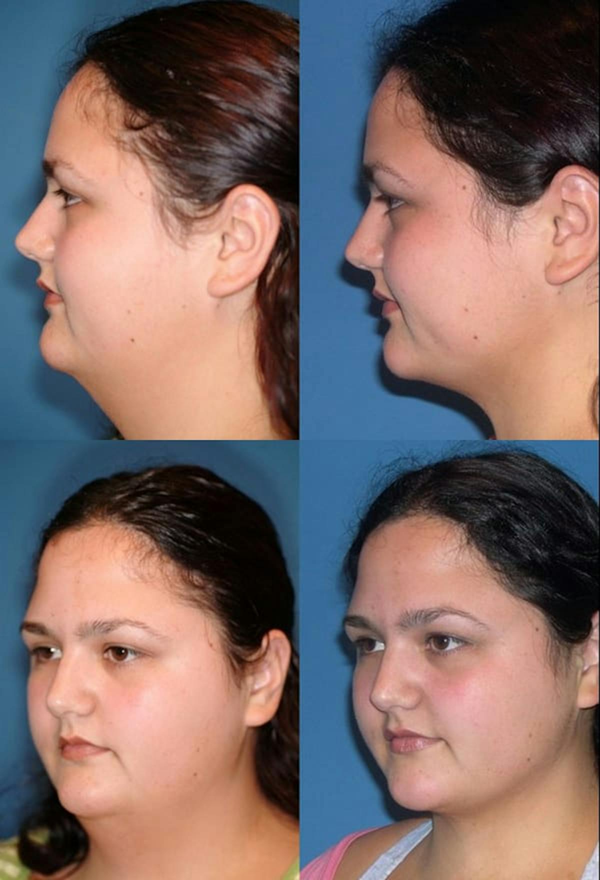 Neck Liposuction Before & After Gallery - Patient 277986 - Image 1