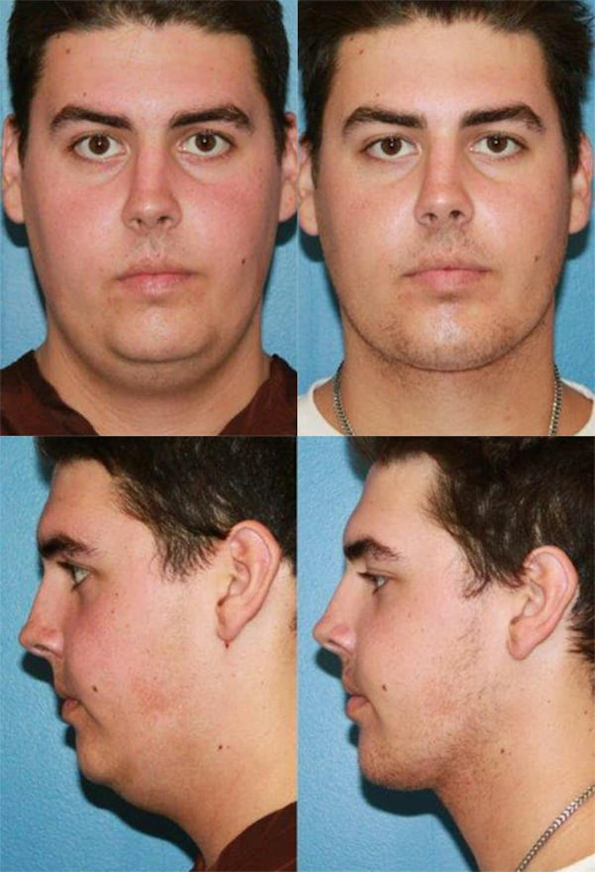 Neck Liposuction Before & After Gallery - Patient 115335 - Image 1