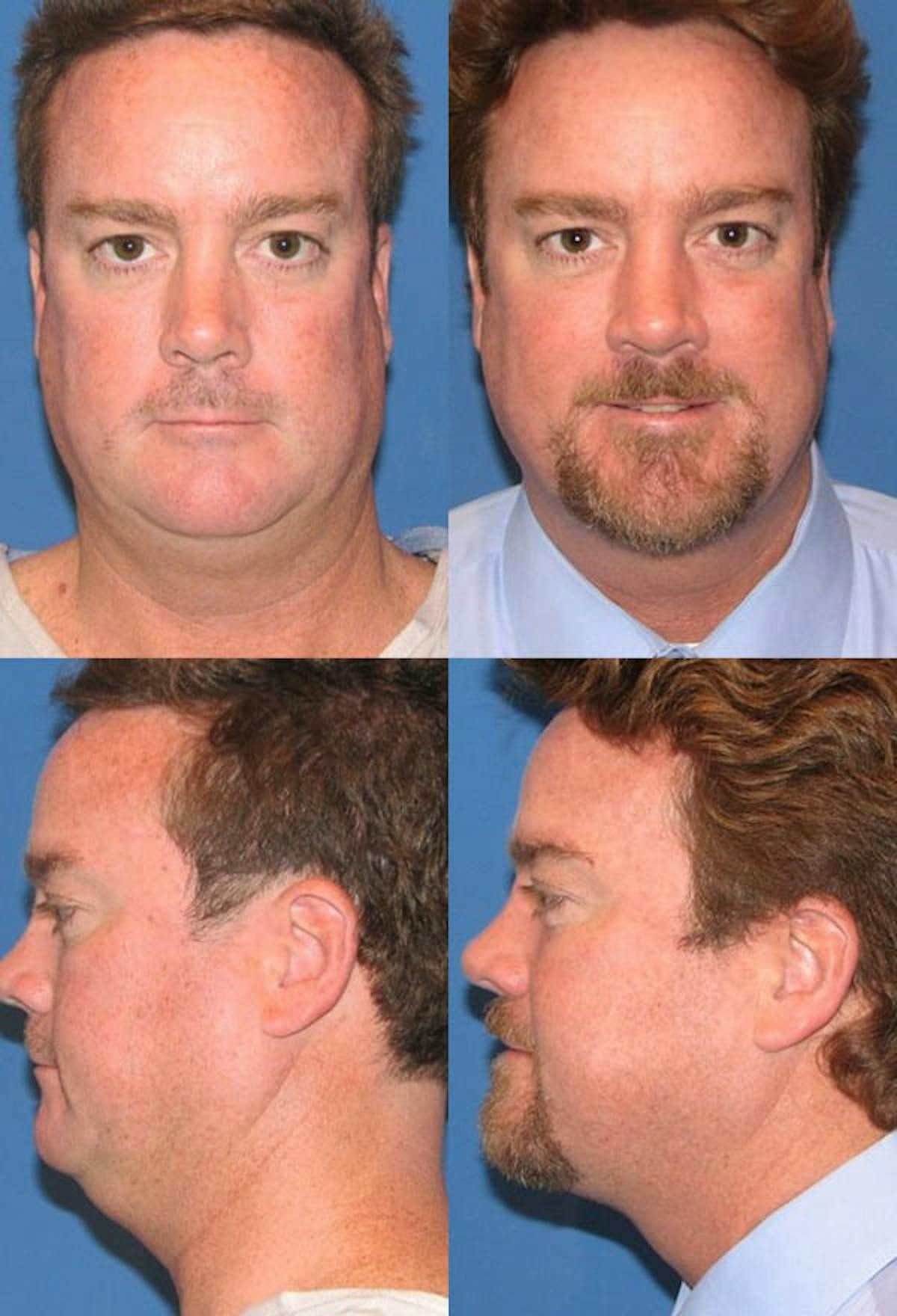Neck Liposuction Before & After Gallery - Patient 413621 - Image 1
