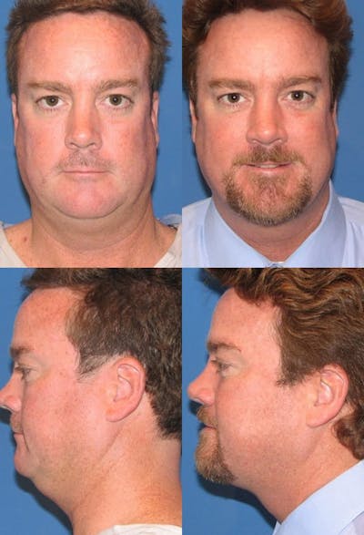 Neck Liposuction Before & After Gallery - Patient 413621 - Image 1
