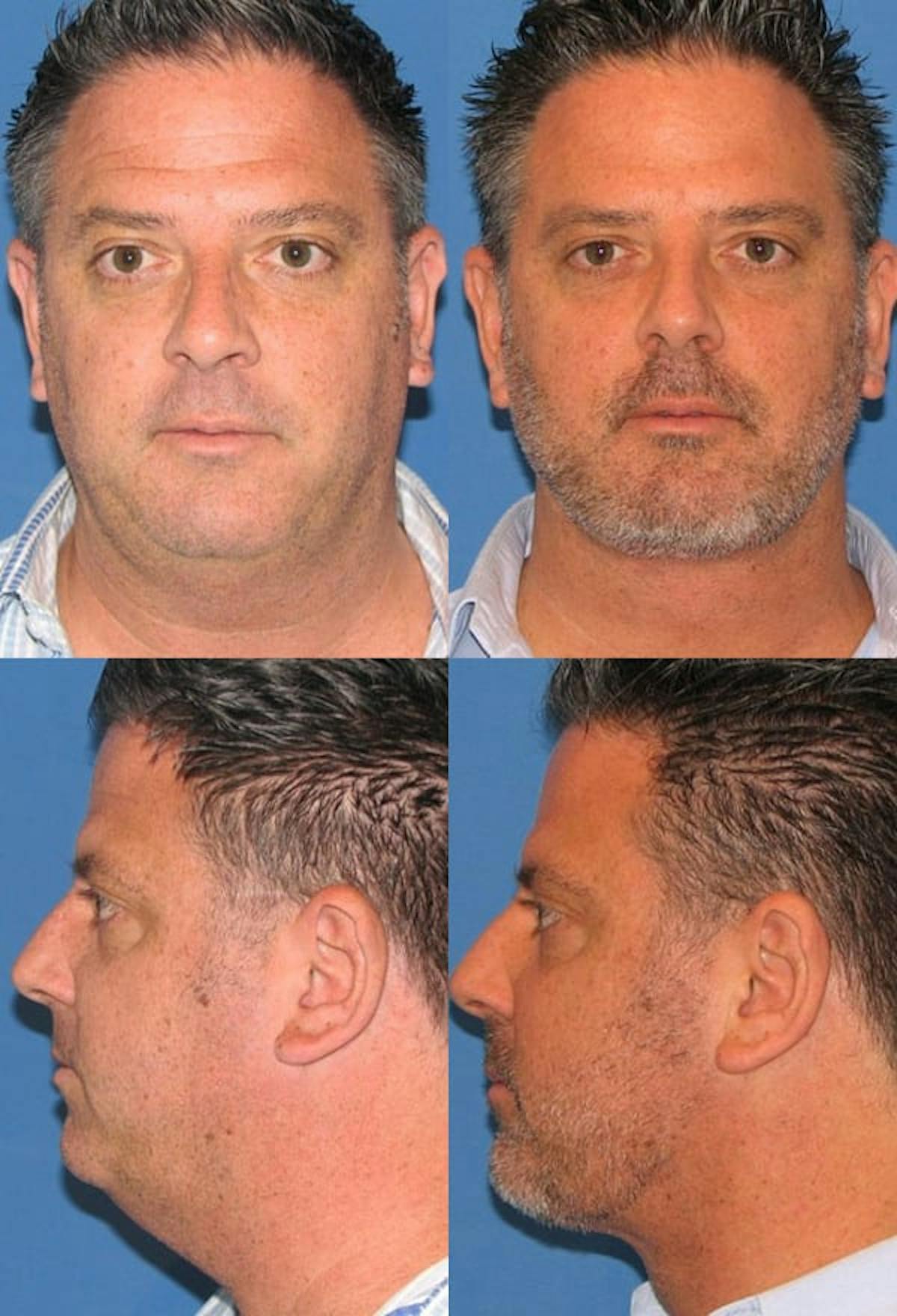 Neck Liposuction Before & After Gallery - Patient 884473 - Image 1