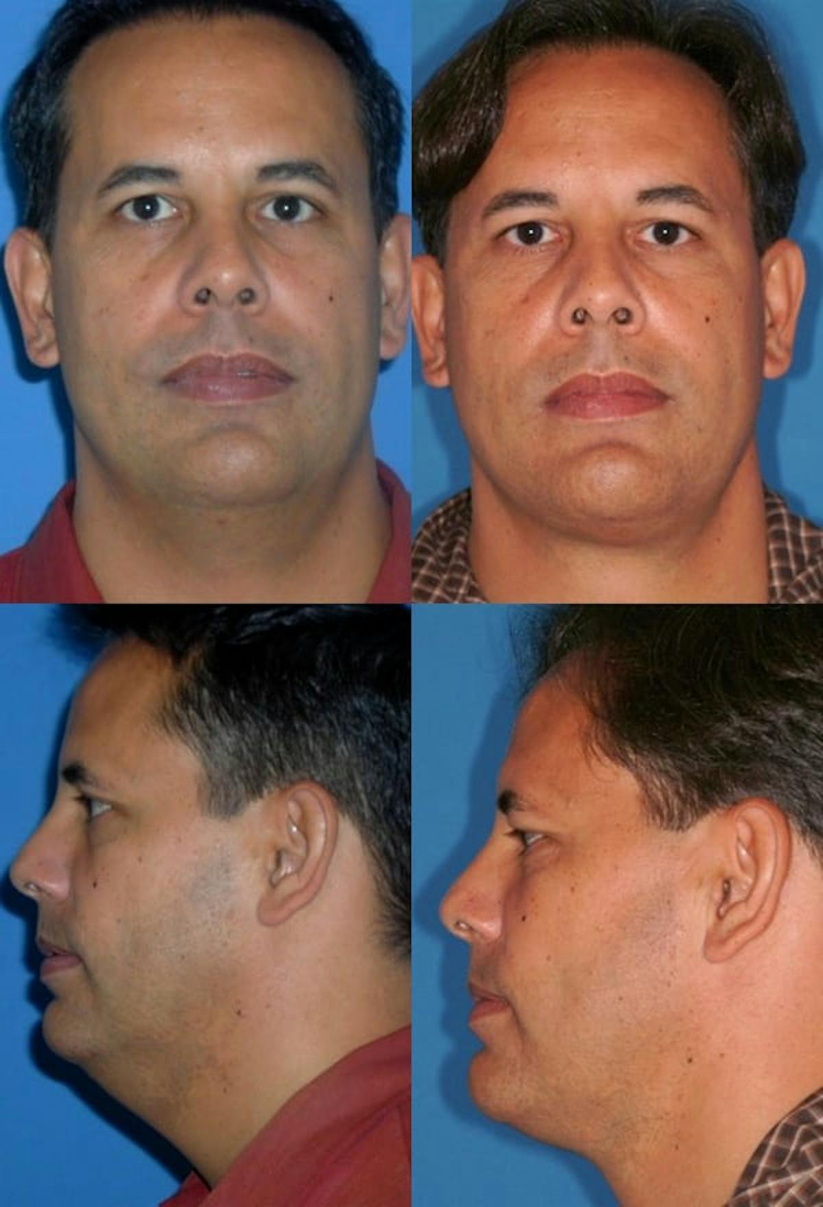 Neck Liposuction Before & After Gallery - Patient 809727 - Image 1