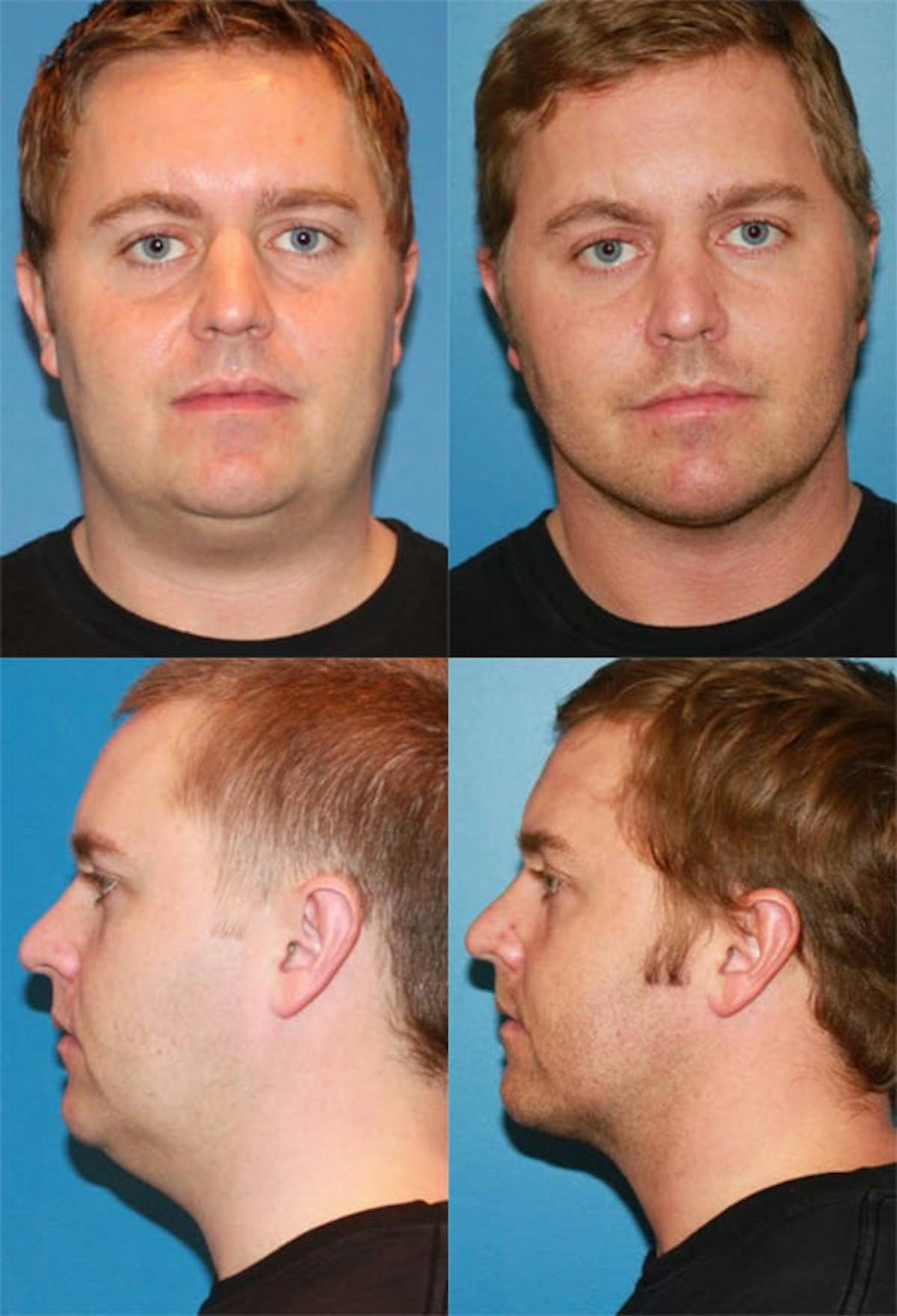 Neck Liposuction Before & After Gallery - Patient 374816 - Image 1