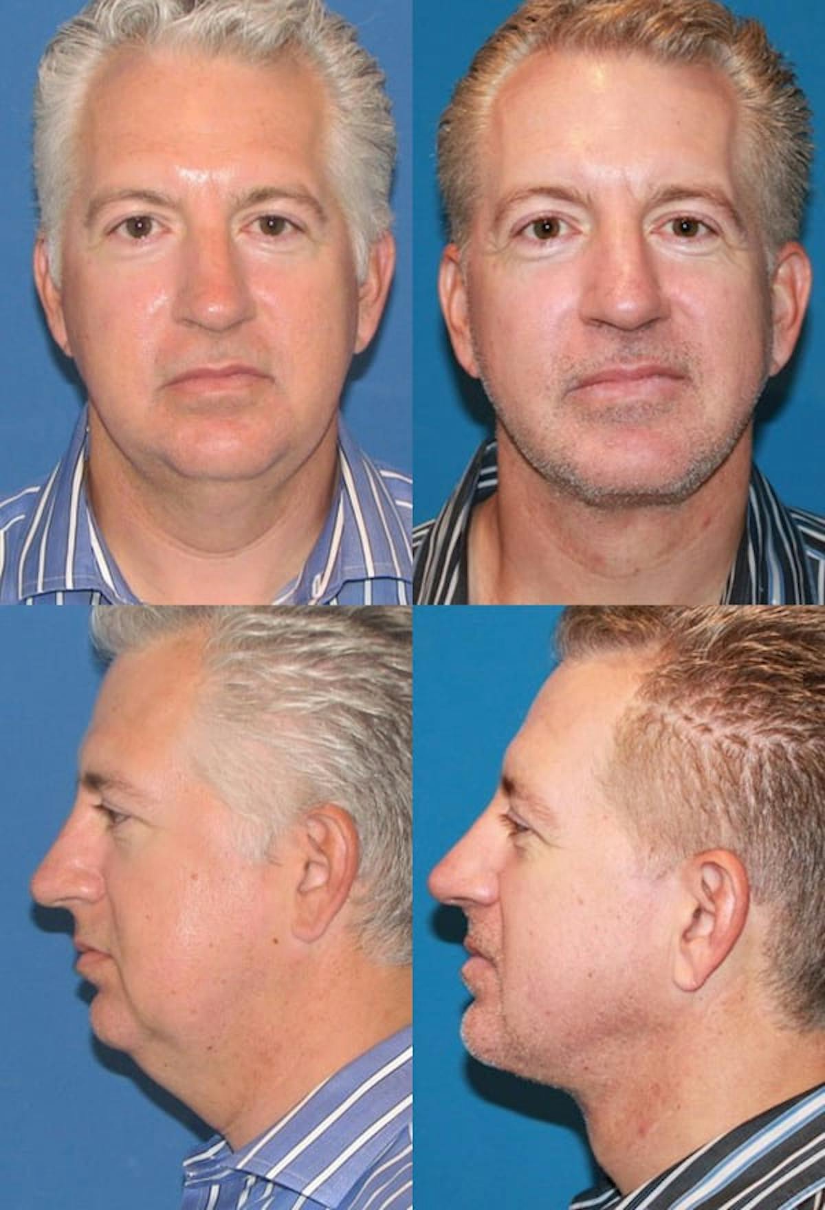 Neck Liposuction Before & After Gallery - Patient 393314 - Image 1