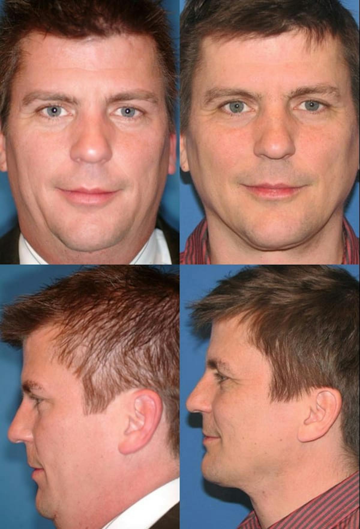 Neck Liposuction Before & After Gallery - Patient 259264 - Image 1