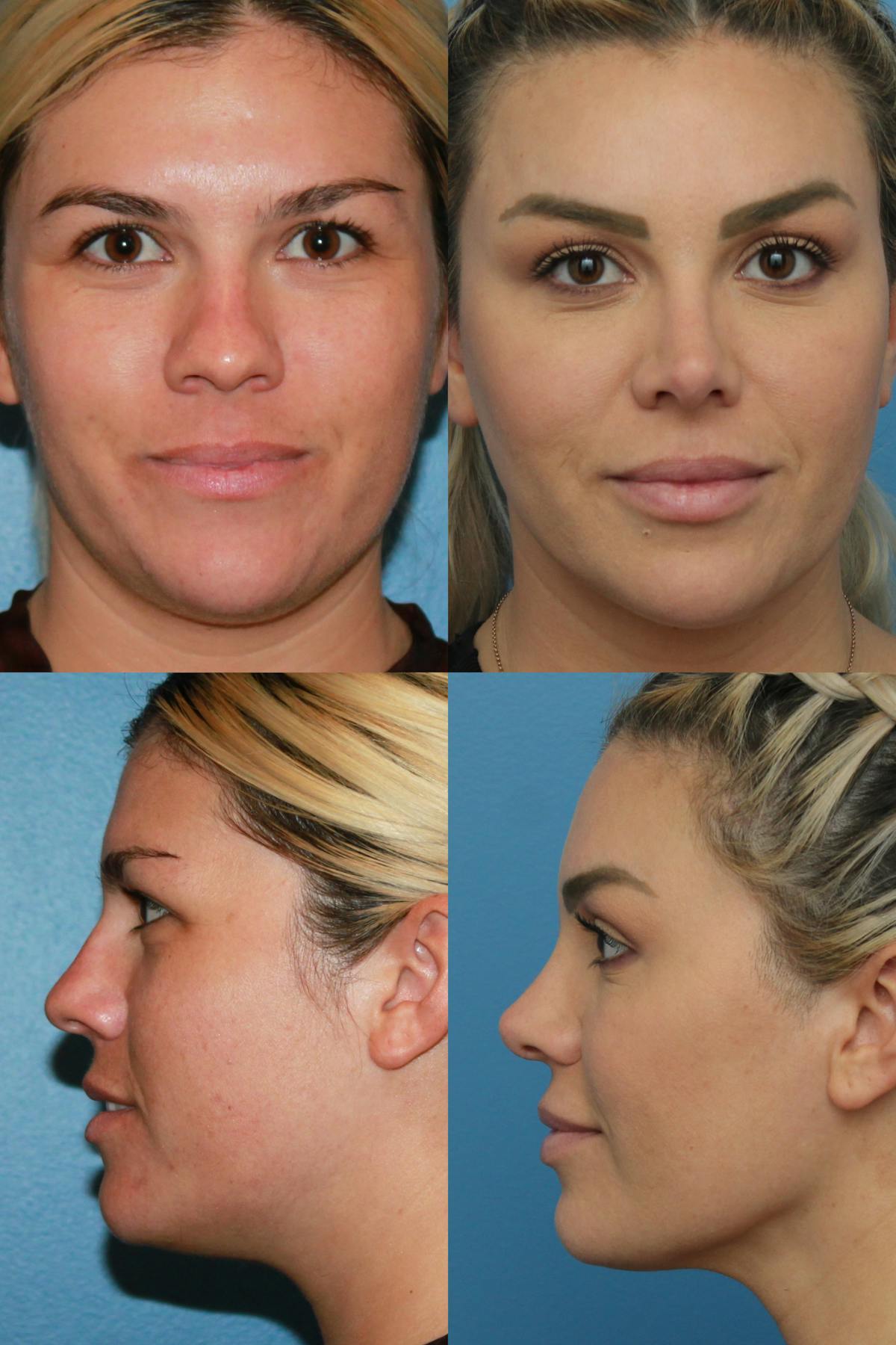 Neck Liposuction Before & After Gallery - Patient 354140 - Image 1