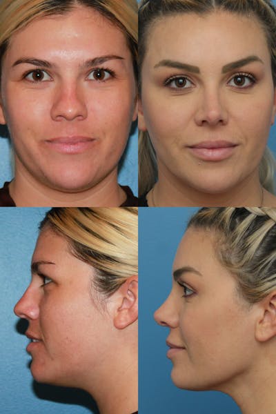 Neck Liposuction Before & After Gallery - Patient 354140 - Image 1